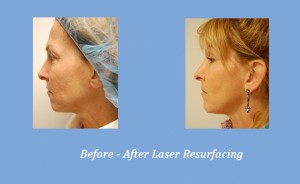 Laser Resurfacing | Georgia Dermatology Center | Alpharetta, GA