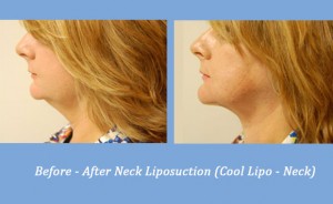 Cool Lipo Liposuction on the Neck | Georgia Dermatology Center