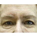 photo showing a set of women's before eyes before Exilis treatment