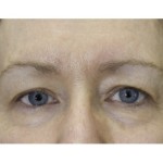 photo showing a set of eyes after Exilis treatment | Dr. Gross