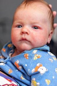 photo of baby with eczema | Georgia Dermatology Center | Cumming, GA