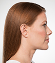 KYBELLA for eliminating double chin | After Photo