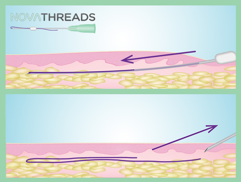 illustration showing NovaThreads | Georgia Dermatology Center