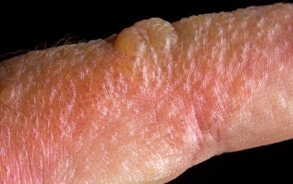 Close up photo of poison ivy rash blisters on human skin