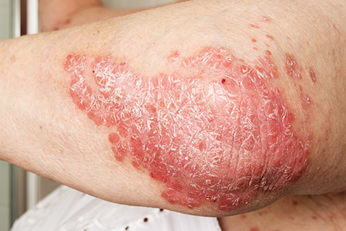 up close photo of Psoriasis, psoriatic skin disease on elbow