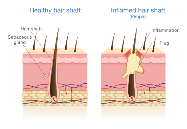 folliculitis | medical illustration showing inflamed hair shaft