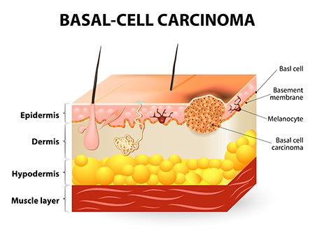 Basal Cell